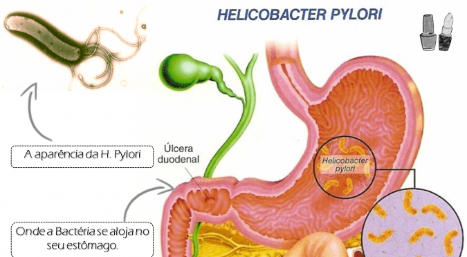 Gastritis por Helicobacter Pylori 